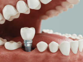 implantes-dentales